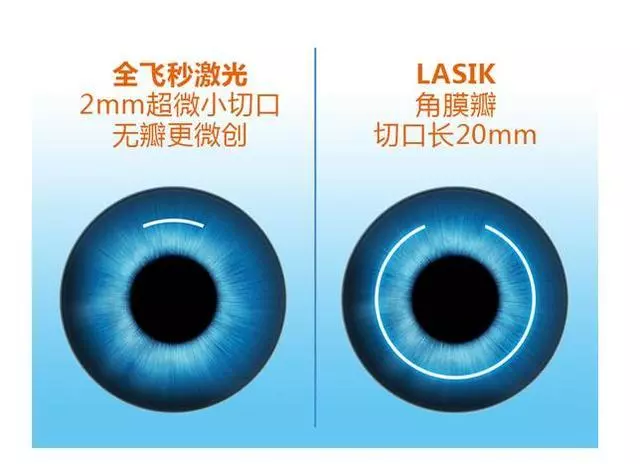 一篇文章詳解「近視眼雷射手術」,這些利弊你需要知道