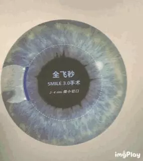 一篇文章詳解「近視眼雷射手術」,這些利弊你需要知道