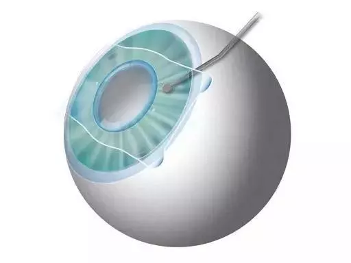 一篇文章詳解「近視眼雷射手術」,這些利弊你需要知道