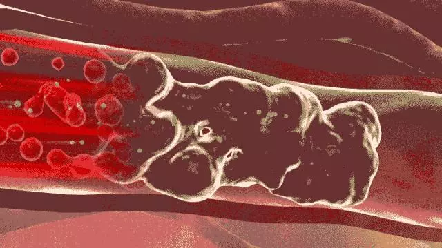 可怕!8張動圖揭秘血管堵的全過程!要想不堵做好這5點!