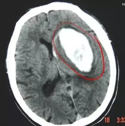 為什麼「中風」越來越多?醫生奉勸:3種食物別吃,會「加速」血管堵塞,再喜歡也要忌口