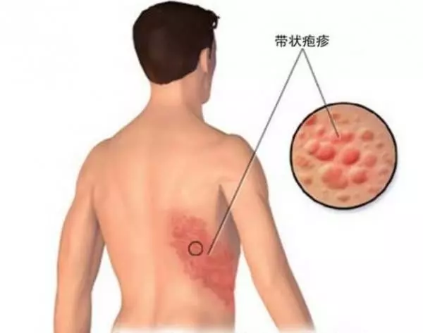 生 蛇 生 到 蛇 纏 腰 , 婆 婆 用一 種 野 草 泡 水 立 刻 搞 定