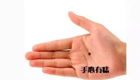 眉心、耳後、手指等這5處的痣千萬別點,代表著富貴,你有嗎?