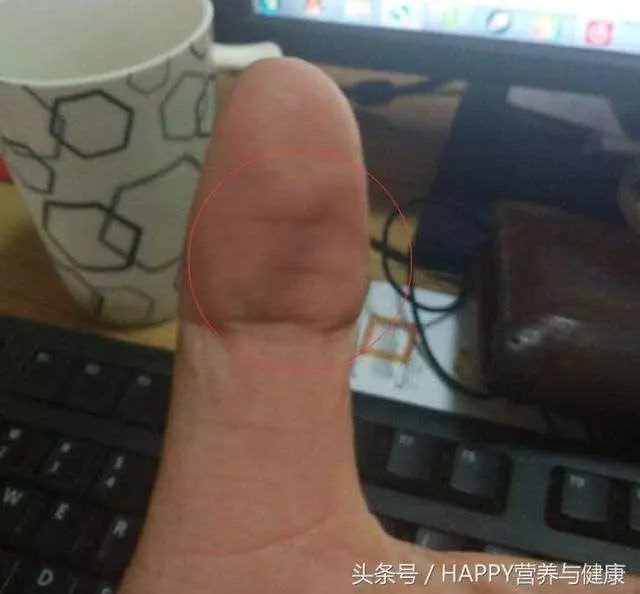 大拇指出現「這一信號」,是中風前兆!教你一套手指操如何預防中風!!