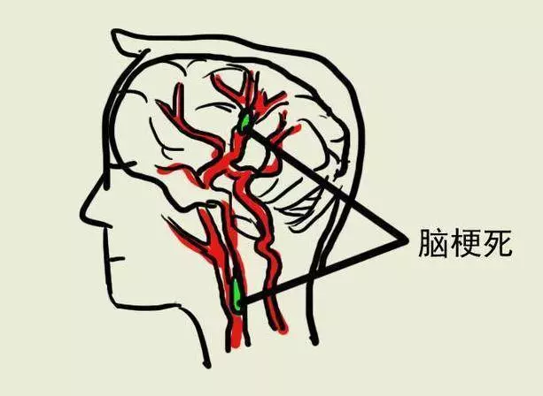 睡覺時,有這種表現就是中風前兆!一定要警惕哦!