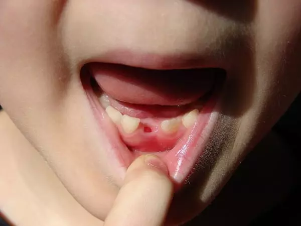 別再把「小孩掉落的乳牙」扔掉了!最新研究證明:關鍵時刻可救自己一命!