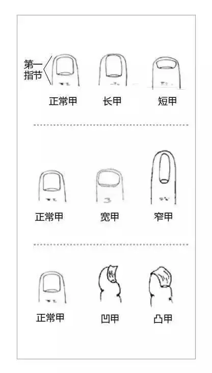 健康指甲全圖鑑:指甲長成這樣,要小心疾病找上門! -