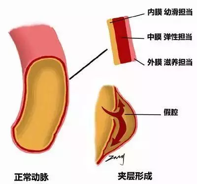 52歲男子,背痛一天,驟然離世,醫生措手不及,這病真的太兇險
