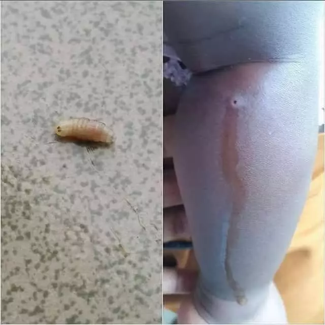孩子身體出現四個小洞口,媽媽以為有膿便擠看看,結果她被嚇到了!
