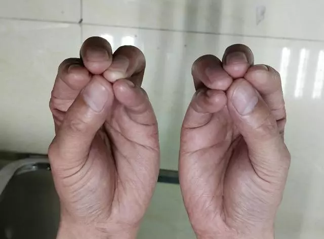 前列腺不好、淋巴有結節,用手做1個動作,堅持49次,非常有幫助