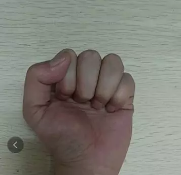 手上有一個降血壓穴,每天按6分鐘,穩定血壓,爬樓梯也不氣喘了