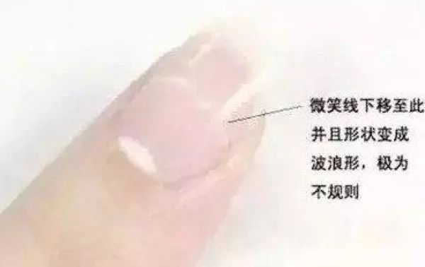 從手指甲就可以看出一個人的健康!你知道指甲上一條一條的橫紋縱紋代表什麼意思嗎?