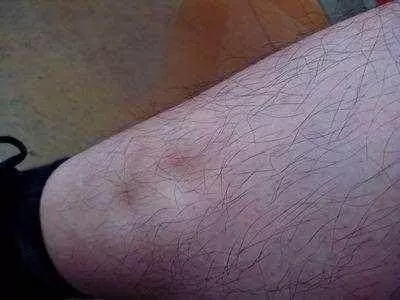 肝癌來臨之前,身體會發出4次警告!可惜太多人都錯過了,需警惕