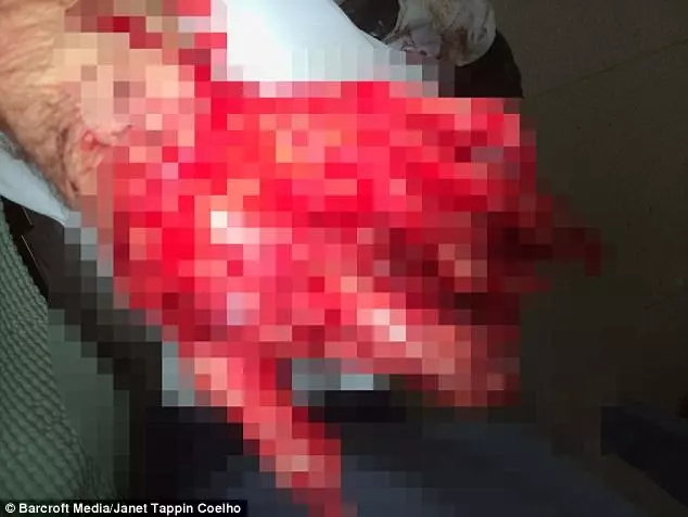 這個工人的手掌整隻斷掉後「醫生直接把手縫進肚子裡」,現在拿出來一看大家都不敢相信會變那樣!
