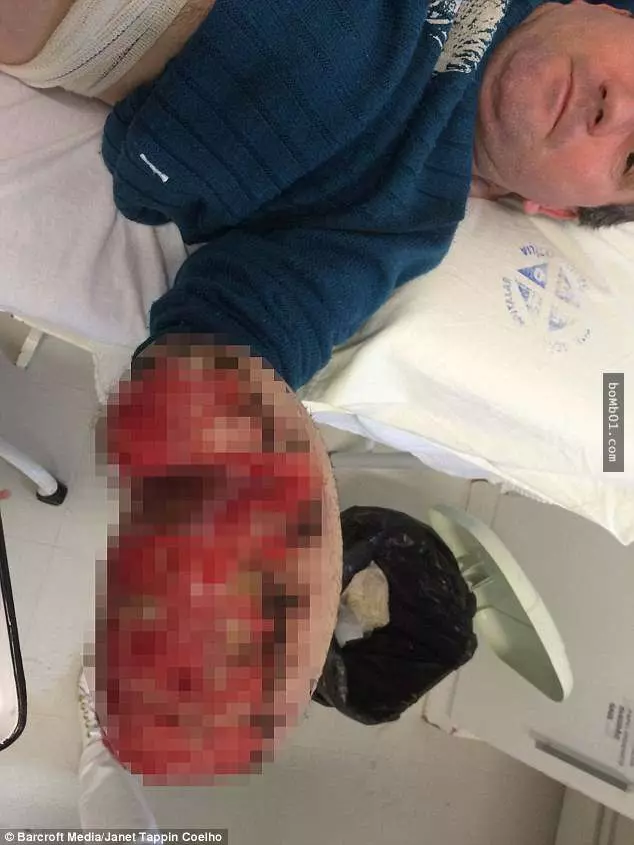 這個工人的手掌整隻斷掉後「醫生直接把手縫進肚子裡」,現在拿出來一看大家都不敢相信會變那樣!