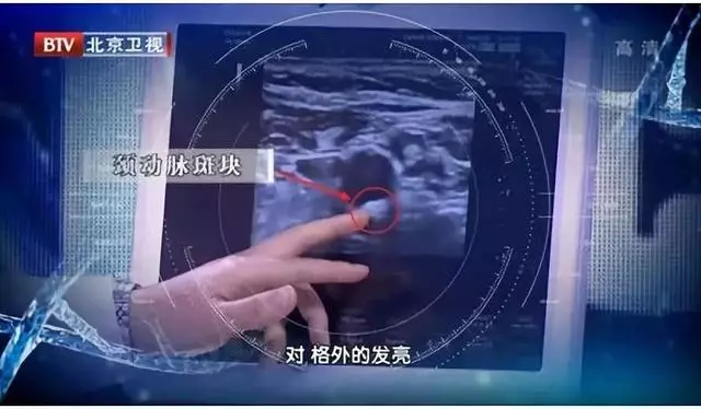 心腦血管好不好?看手知道!醫生提醒:5個地方長青筋,要注意了