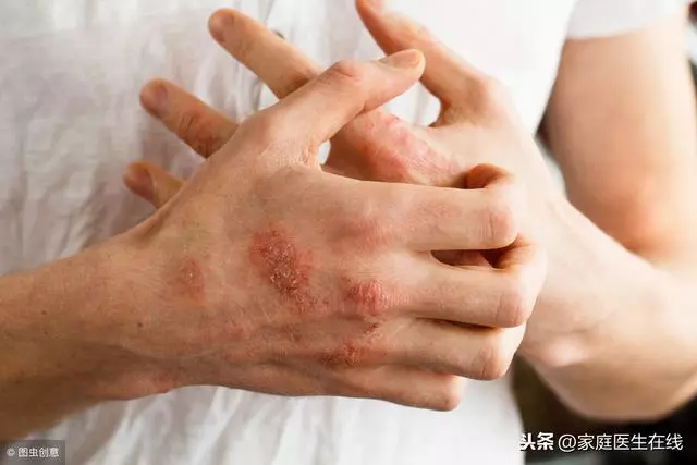 濕疹和汗皰疹,傻傻分不清?3個區別教你認清楚!