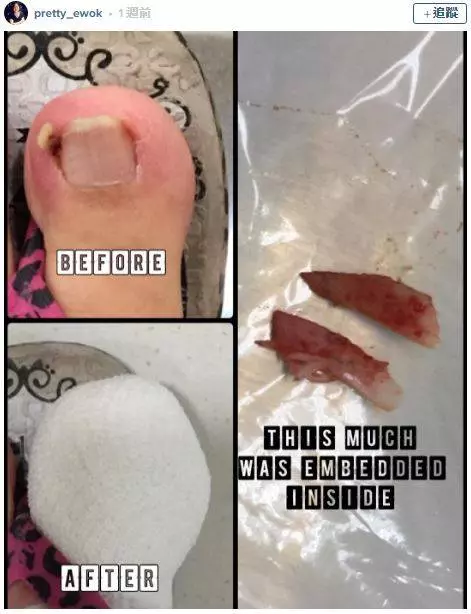17個會讓人覺得超噁爛的「腳指甲知識」 人類的腳指甲其實是爪子