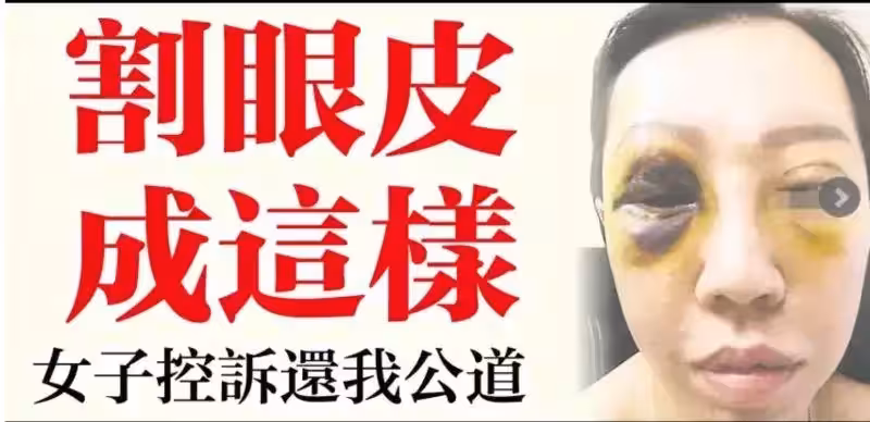 「「原想美美過新年」割眼皮成這樣·····! 」女子控訴還我公道