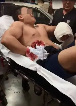對方以巴冷刀砍傷,其腹部、腳部及手部深受重傷後送院