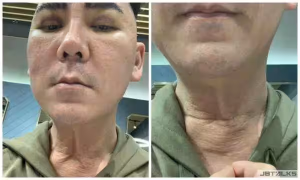 整容失敗損失重!李榮達:「我不在乎錢!整容為了好看現在沒法忍!」