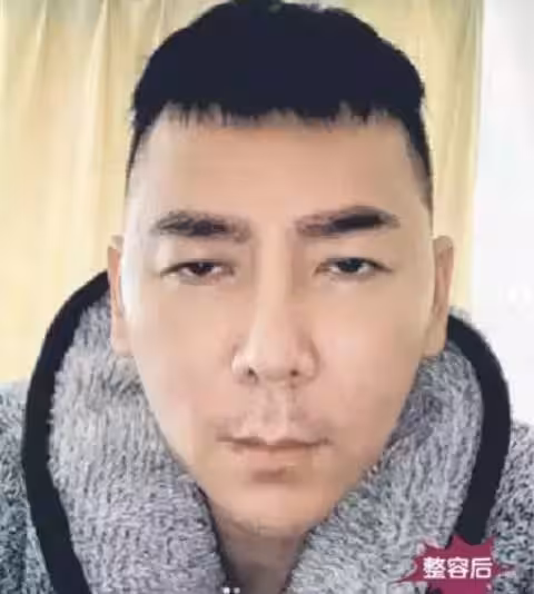 整容失敗損失重!李榮達:「我不在乎錢!整容為了好看現在沒法忍!」