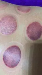 拔罐真的可以排毒嗎?告訴你拔出的顏色深淺代表什麼意義