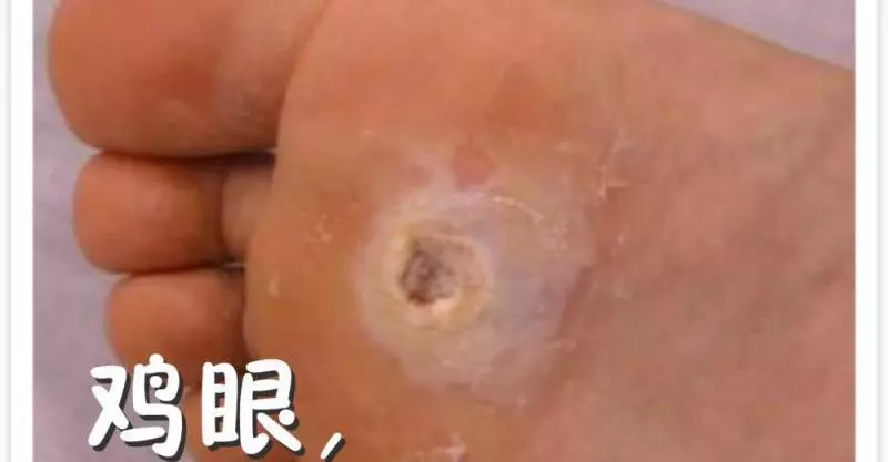 明燈醫學:雞眼,用熱豬油一抹就好,效果都非常明顯,對皮膚還沒有傷害。