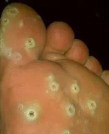 明燈醫學:雞眼,用熱豬油一抹就好,效果都非常明顯,對皮膚還沒有傷害。