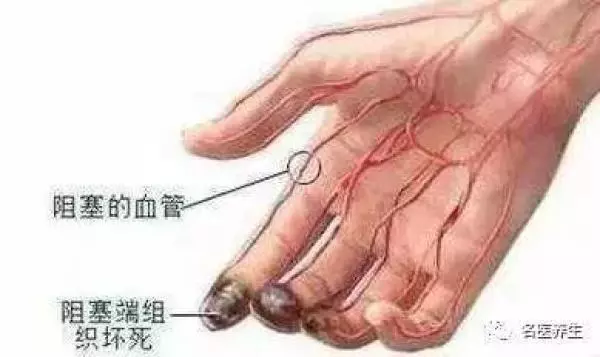 再不注意這6個信號!你的血管就要堵了!