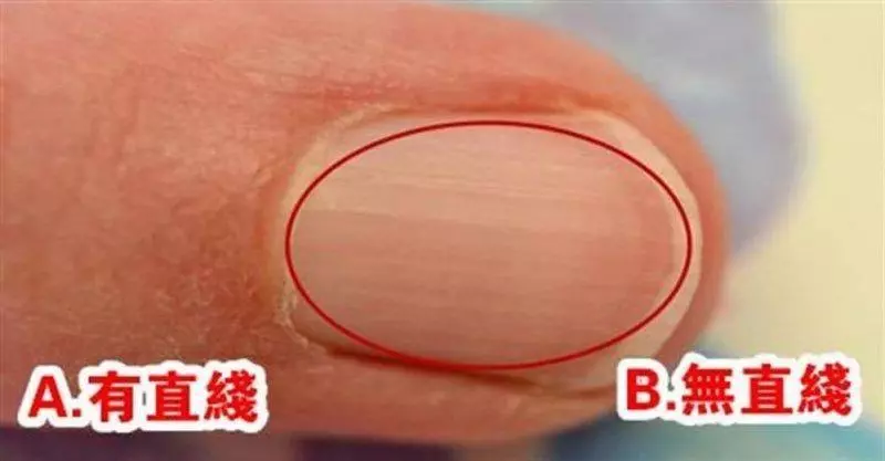 你的指甲上有一道道直線嗎?性格命運大不同,據說很準