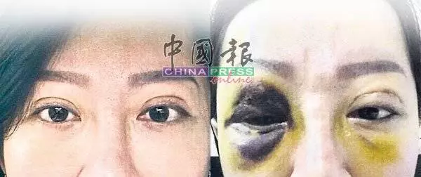 【整容變毀容!】大馬愛美女子埋線失敗險成獨眼龍大走樣,美容院業主澄清:我是合法的!