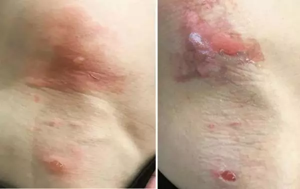 陳邦鋆被燙傷敷藥 痛到冒汗 大叫 發抖 噴口水 !
