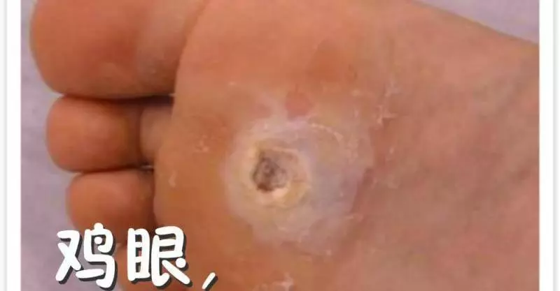 明燈醫學:雞眼,用熱豬油一抹就好,效果都非常明顯,對皮膚還沒有傷害。