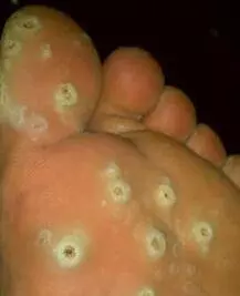 明燈醫學:雞眼,用熱豬油一抹就好,效果都非常明顯,對皮膚還沒有傷害。