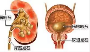 木耳加一物，幫助你排出體內肥油，降低膽固醇和甘油三酯，還能預防腎結石！