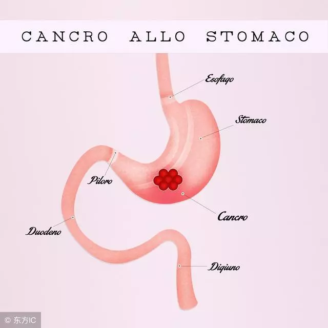 哪些食物可以幫助消滅幽門螺旋桿菌?來看看臨床醫生怎麼說