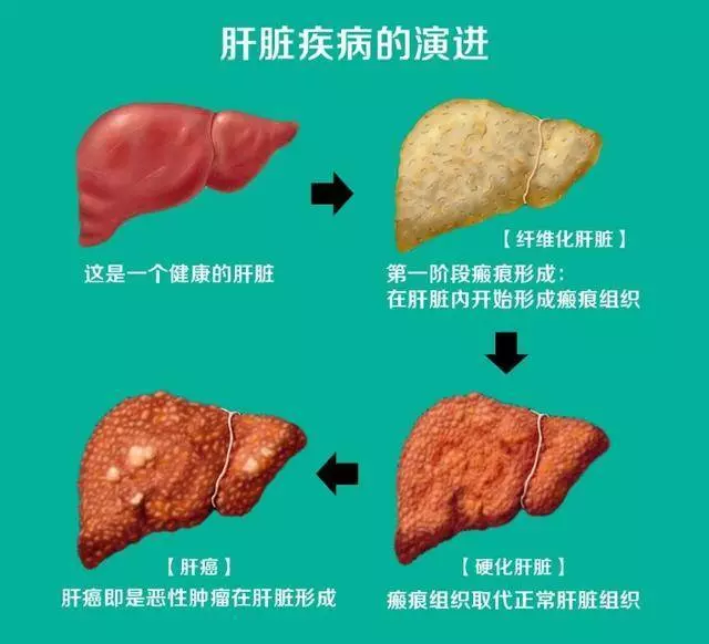 肝不好,除了指甲,這4個地方也會有變化!醫生推薦5個養肝小方法