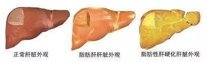 肝不好,除了指甲,這4個地方也會有變化!醫生推薦5個養肝小方法