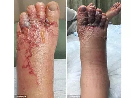 去沙灘一定注意！！新婚夫妻沙灘蜜月旅行，兩人腳底全鑽進恐怖寄生蟲！！
