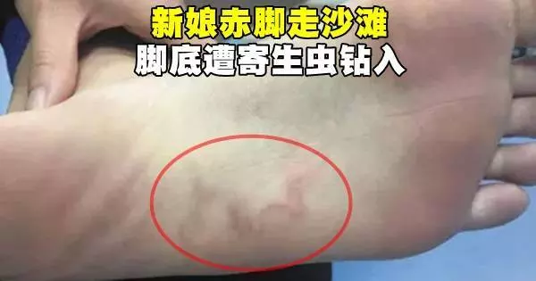 去沙灘一定注意！！新婚夫妻沙灘蜜月旅行，兩人腳底全鑽進恐怖寄生蟲！！