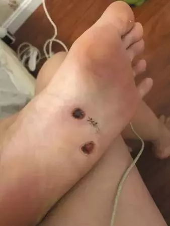 去沙灘一定注意！！新婚夫妻沙灘蜜月旅行，兩人腳底全鑽進恐怖寄生蟲！！
