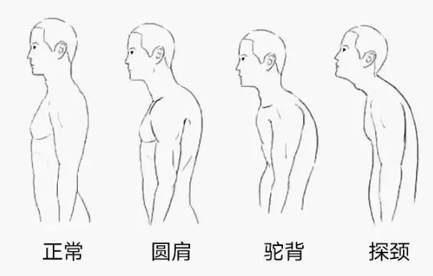 中醫:彎腰駝背好多年?教你3個動作,堅持練腰桿挺了背直了