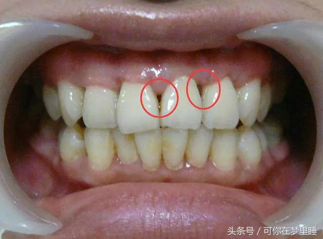 [牙齦]一旦萎縮，就容易[塞牙]、[牙根酸痛]，這方法可以幫到你，很簡單！