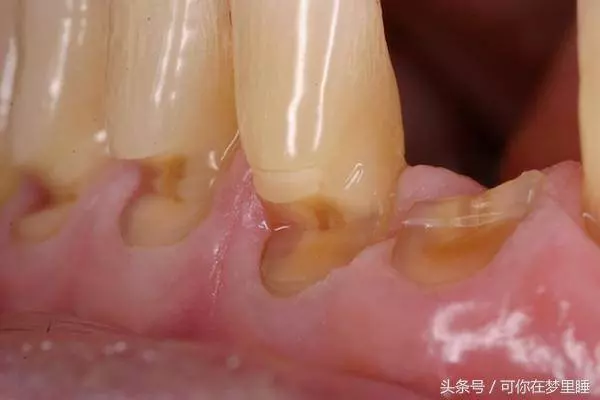 [牙齦]一旦萎縮，就容易[塞牙]、[牙根酸痛]，這方法可以幫到你，很簡單！
