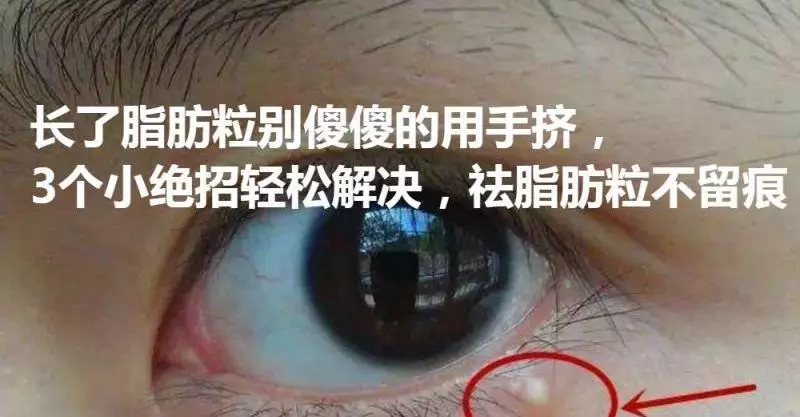 長了脂肪粒別傻傻的用手擠,3個小絕招輕鬆解決,祛脂肪粒不留痕