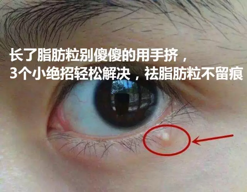 長了脂肪粒別傻傻的用手擠,3個小絕招輕鬆解決,祛脂肪粒不留痕