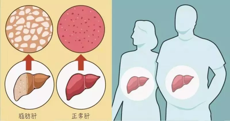 脂肪肝到底有多可怕?這篇文章說透了!_肝臟