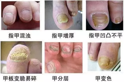 男子腳指甲嚴重畸形生長 連路都不能走了 醫生開刀後所有人都看傻
