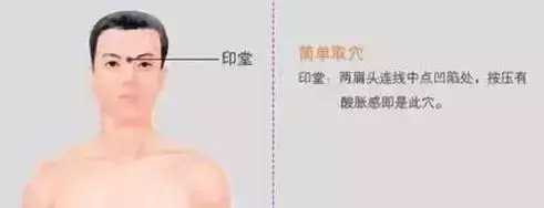 印堂穴為什麼能搞定失眠?